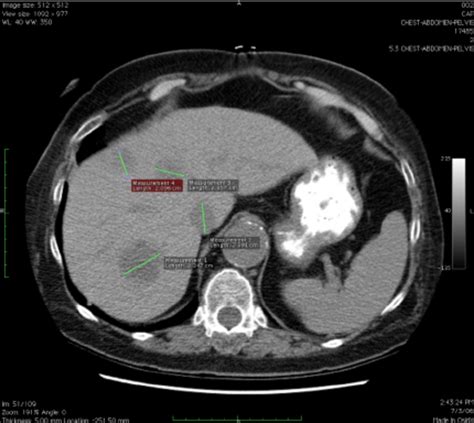 scanliver|scan for liver damage.